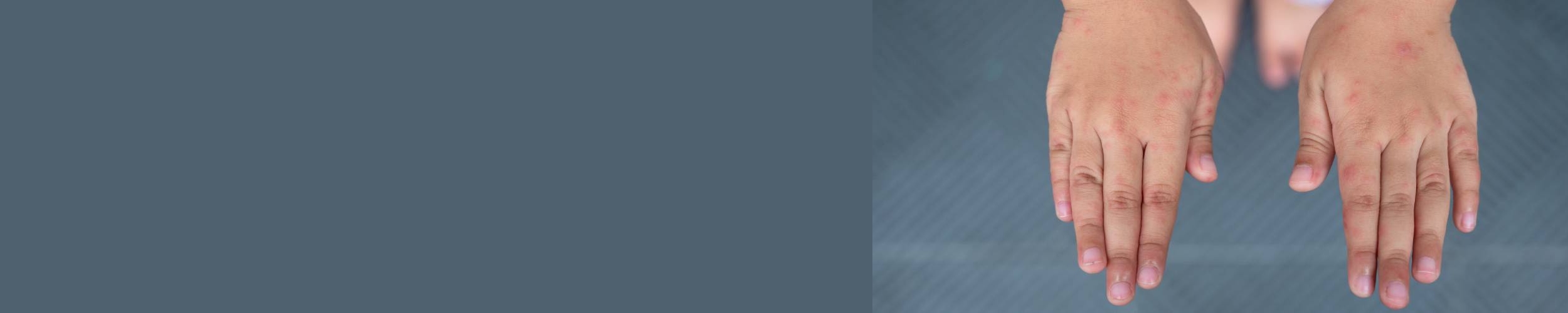 Barn med utslett på hendene