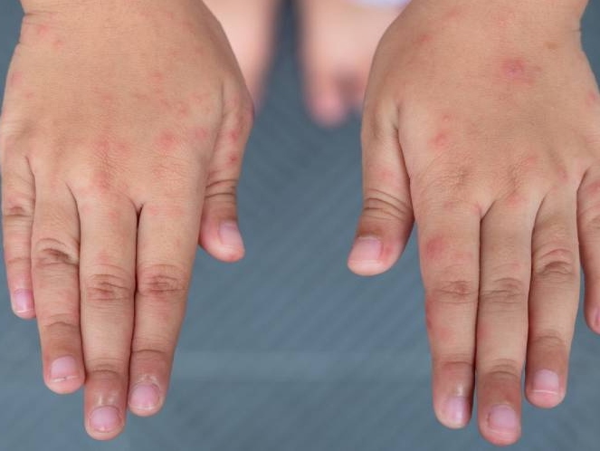 Barn med utslett på hendene