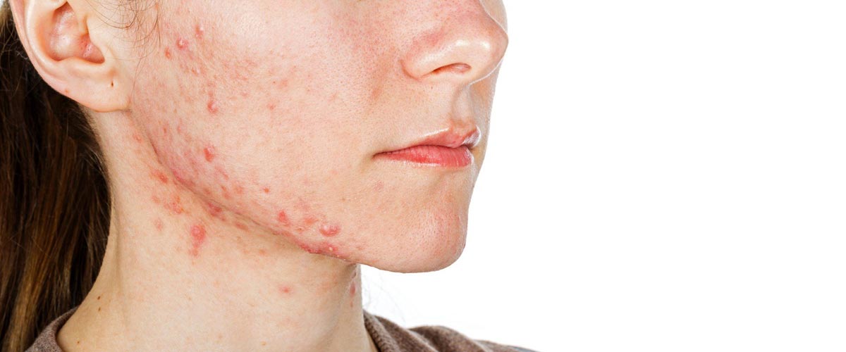 jente med uren hud på ansikt og hals. 