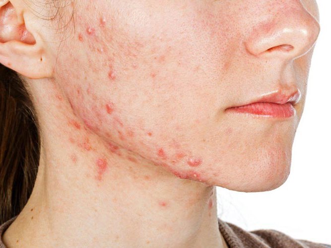 jente med uren hud på ansikt og hals.