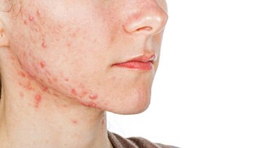 jente med uren hud på ansikt og hals.