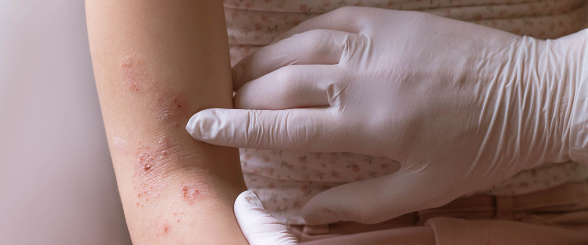 lege med hansker undersøker eksem på arm. 