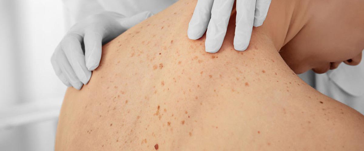 hudlege undersøker rygg for føflekker. 