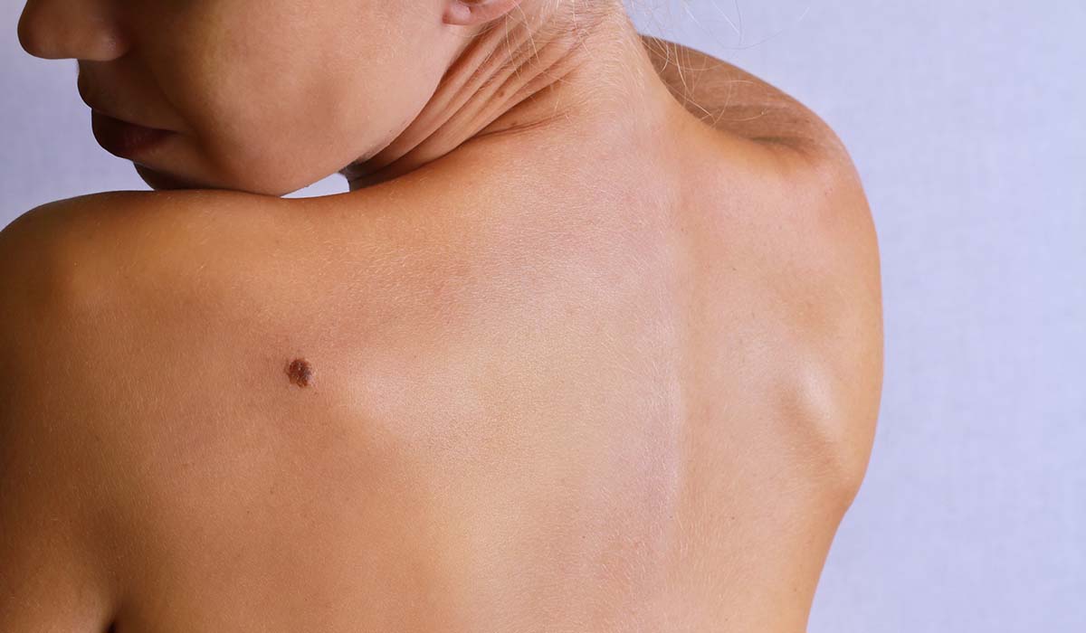 kvinne undersøker føflekk på ryggen. 