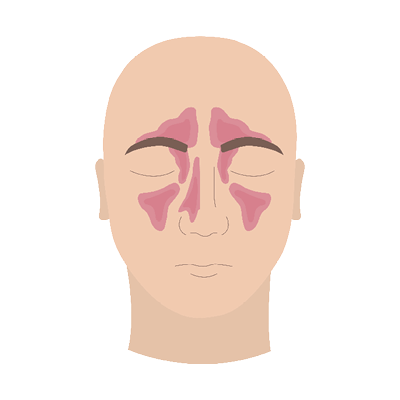 bihulebetennelse, illustrasjon.