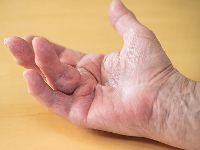 Krokete finger/dupuytrens på gul bakgrunn