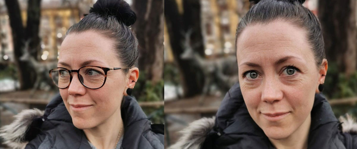 Pasient Hannah med og uten briller, før og etter laseroperasjon på Aleris.