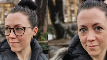 Pasient Hannah med og uten briller, før og etter laseroperasjon på Aleris.