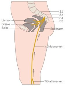 tibialisstimulering. 
