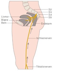 tibialisstimulering.