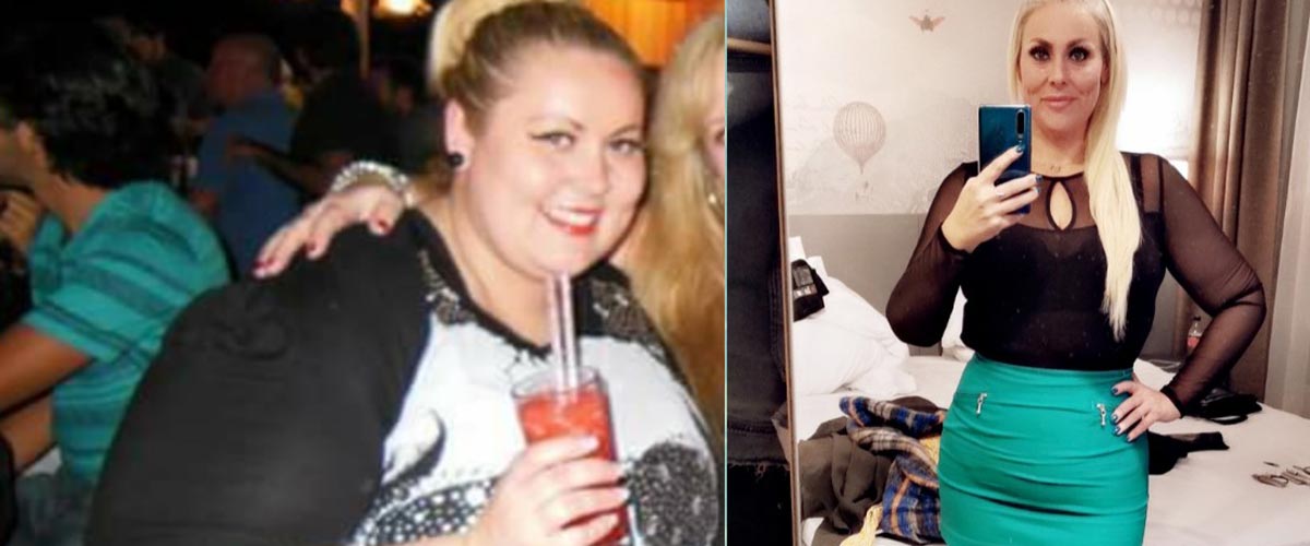 Anita før og etter SASI-operasjon.