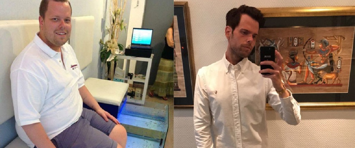 Tom før og etter slankeoperasjon. 